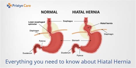 Everything You Need To Know About Hiatal Hernia Pristyn Care