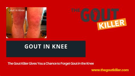 Gout Knee Causes Symptoms Treatment Knee Pain Explained Rezfoods