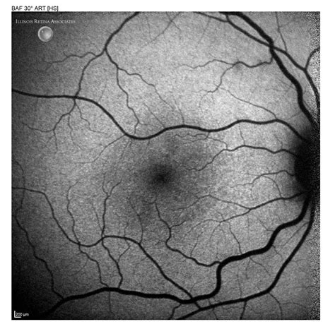 Acute Macular Neuroretinopathy May 2023 Illinois Retina Associates