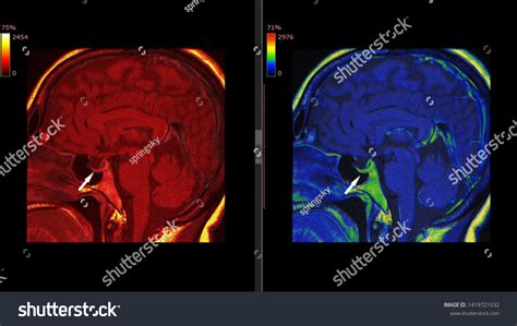 Pituitary Gland Hypophysis Mri Scan Magnetic Stock Illustration