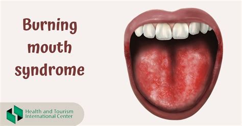 What Are The Symptoms If Burning Mouth Syndrome Hti Centers