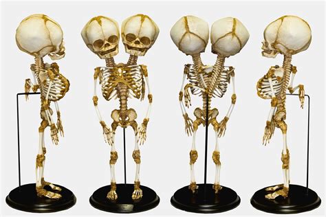 Two Headed Fetal Skeleton