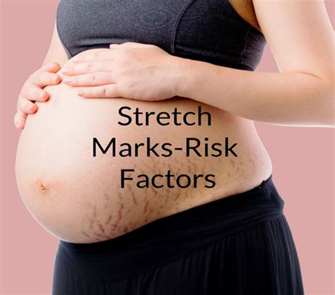 Stretch Marks Removal In Singapore Risk Factors And Diagnosis