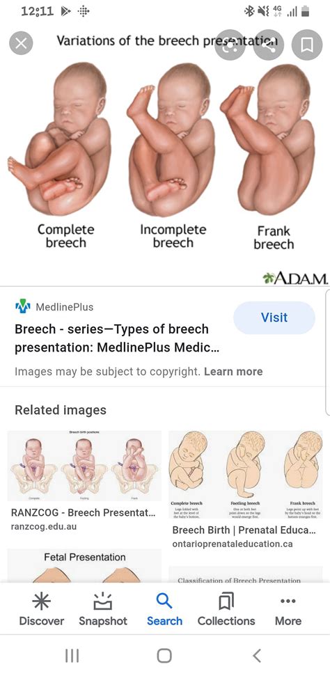 Frank Breech Baby Babycentre