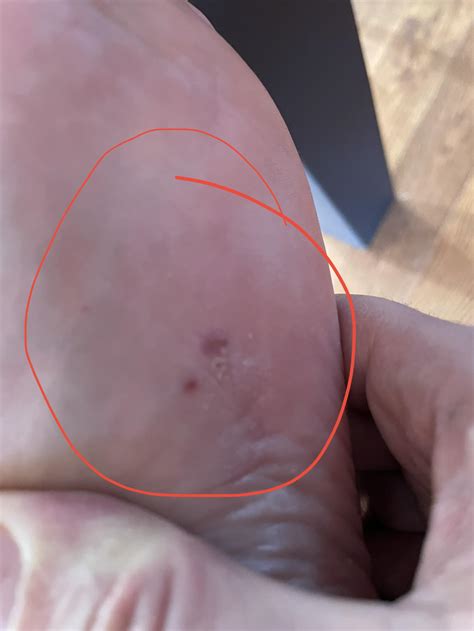 Itchy bumps on bottom of foot. Does anyone know what this is? Is it a