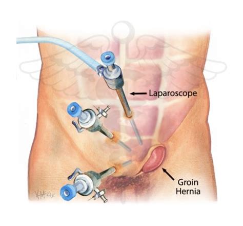 Which Is A Better Option For Inguinal Hernia Open Or Laparoscopic Surgery