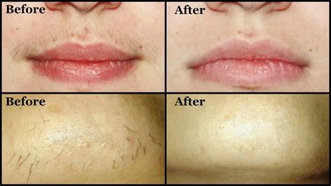 How To Remove Unwanted Upper Lip Hair And Chin Hair By Yourself Easily At
