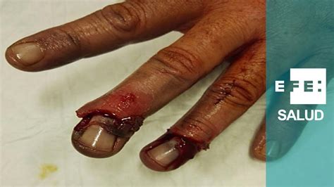 Microcirugía Para Reimplantar Dedos De La Mano Youtube