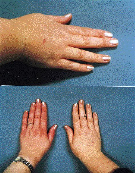 One Swollen Hand The Lancet