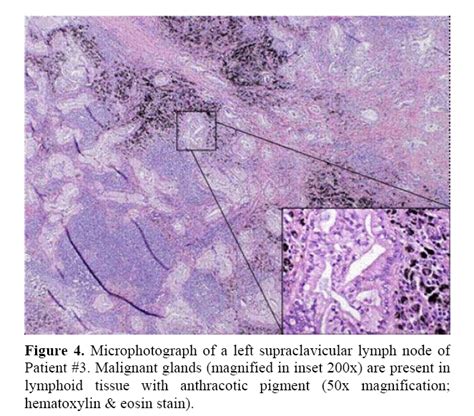 Isolated Supraclavicular Lymph Node Metastasis In Pancreatic Aden