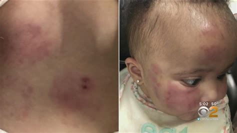 Exclusive 6 Month Old Infant Left Covered In Bruises At Unlicensed New
