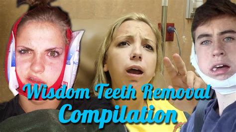 Wisdom Teeth Removal Compilation 2017 Youtube