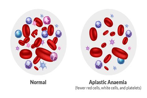 Aplastic Anemia Causes Symptoms Treatment Options