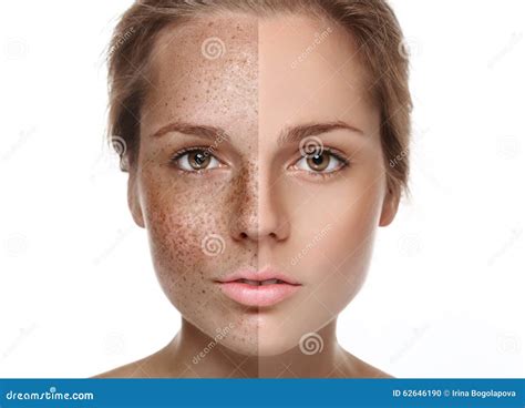Woman Freckle Half Face Happy Young Beautiful Portrait Healthy Skin