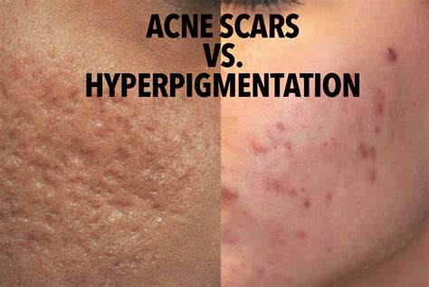 The Difference Between Hyperpigmentation And Scarring Justinboey