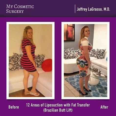 Before And After A Brazilian Butt Lift By Jeffrey Lagrasso M D At My