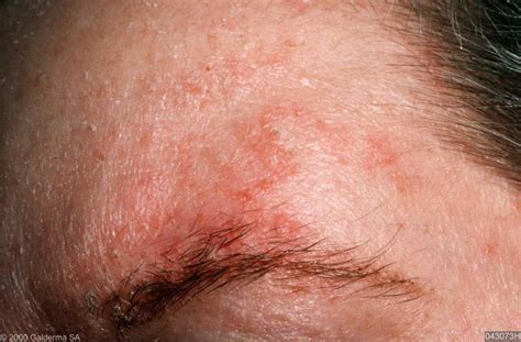 Dry Rash On Face Pictures Photos