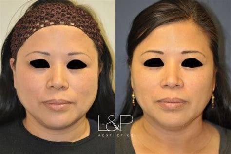 Ultherapy® Before And After Photos Case 86 Palo Alto And San Jose