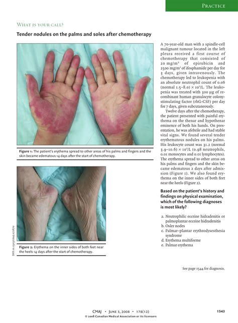 Pdf Tender Nodules On The Palms And Soles After Chemotherapy