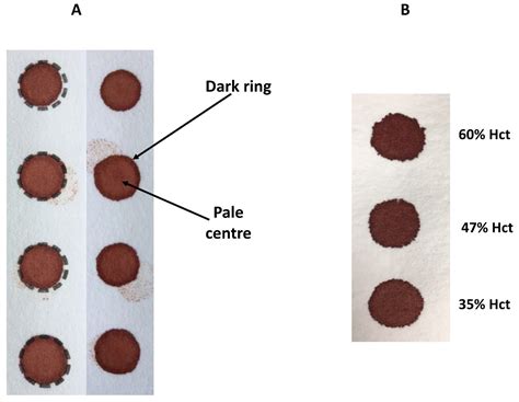 Ijns Free Full Text Use Of Dried Blood Spot Specimens To Monitor