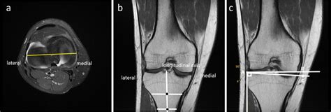 Illustration Of Coronal Tibial Slope Measurement On T1 Mri Sequence A