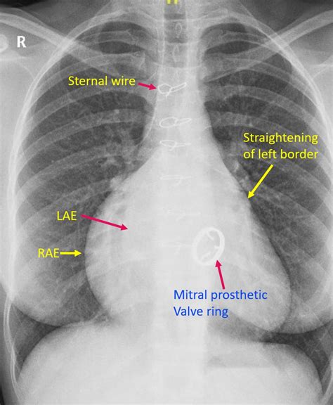 Prosthetic Mitral Valve On Cxr All About Cardiovascular System And