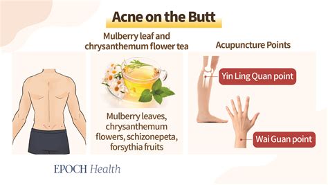 Body Acne These Key Locations Signify Health Issues The Epoch Times