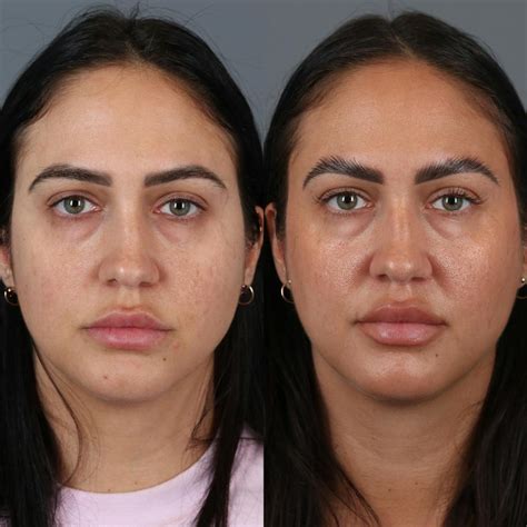 Patient 123430789 Buccal Fat Removal Before And After Photos Vila