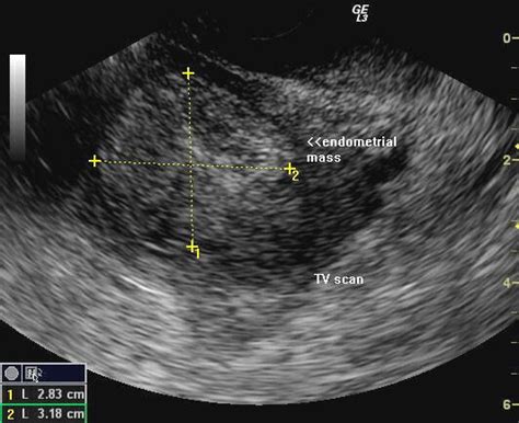 What Does Ovarian Cancer Look Like On An Ultrasound What Does