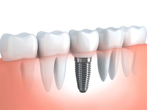 Single Tooth Dental Implants In Federal Way Wa Dentist