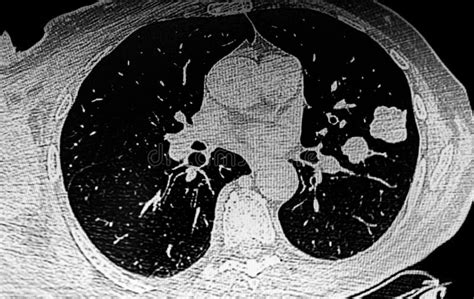 Chest Ct Scan Showing Left Lung Tumors Stock Image Image Of Medical Adult 223323719