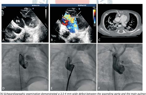 Figure 1 From Transcatheter Closure Of Aortopulmonary Window In Infants