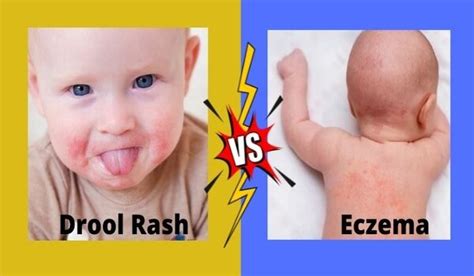 Difference Between Drool Rash And Eczema The Mindful Bytes