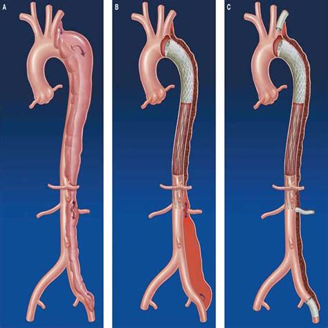 Aortic Dissection Nursestudynet