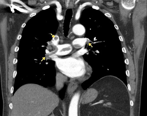 Pulmonary Embolism Pregnancy