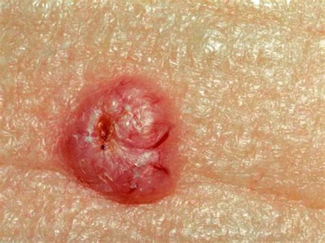 Fda Approves Drug For Basal Cell Carcinoma Medpage Today
