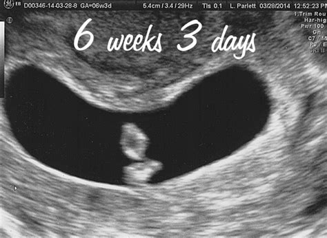 6 Weeks Pregnant Symptoms Ultrasound Spotting And Cramping