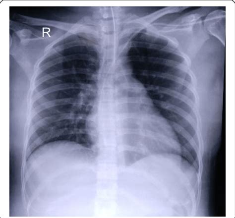 Chest X Ray On Day 3 Of Hospitalization Download Scientific Diagram