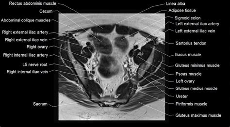 Anatomy and pathology of the male pelvis by magnetic resonance imaging. mri female pelvis anatomy axial image 11 | Pelvis anatomy ...