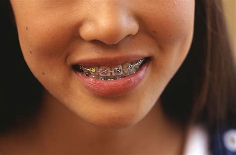 Tooth Braces and Pain | Healthfully