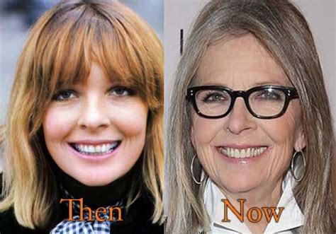 Diane Keaton Plastic Surgery Before And After Facelift Photos
