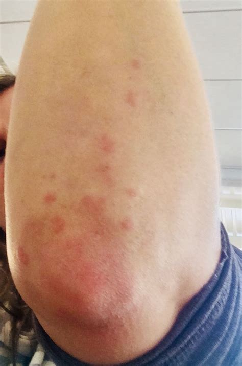 According to the american diabetes association, about 34 million people in the united states — both adults and children — are living with diabetes, and an additional 1.5 million people are diagnosed every year. Dermatitis Herpetiformis, elbow | Dermatitis herpetiformis