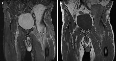 A Rare Case Of Sigmoid Colon Perforation With Subsequent Psoas Abscess