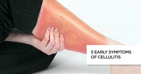5 Early Symptoms Of Cellulitis Causes Treatment And Faq S