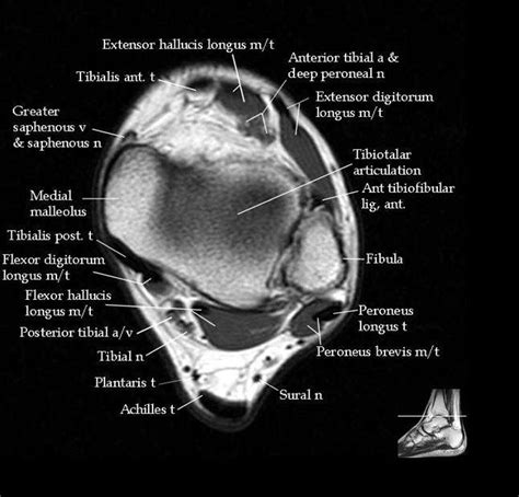 Routine ankle magnetic resonance imaging (mri) tests involve taking images of the foot the mri machine uses radio wave energy pulses and a magnetic field to produce the foot and ankle images. 52 best images about MRI anatomy on Pinterest | Head and ...