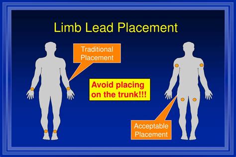 Ppt Introduction To 12 Lead Ecgs Powerpoint Presentation Free