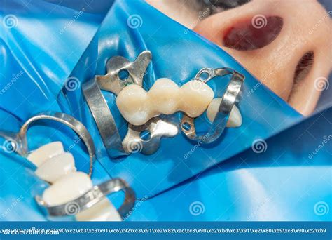 Restoration Of Teeth After Endodontic Treatment With Fiberglass Pins