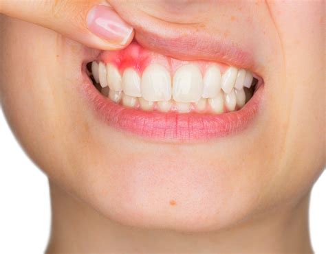 Nadżerki w jamie ustnej jakie są przyczyny nadżerek w ustach wylecz to