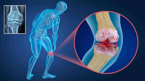 Doenças Dos Ossos E Articulações