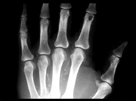 Aneurysmal Bone Cyst Findings Expansile Lytic Lesion Of